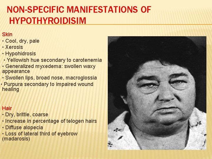 NON-SPECIFIC MANIFESTATIONS OF HYPOTHYROIDISIM Skin • Cool, dry, pale • Xerosis • Hypohidrosis •