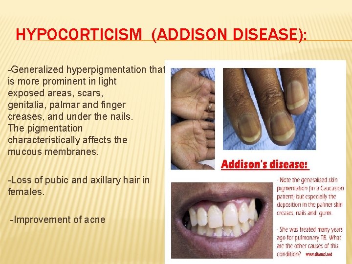 HYPOCORTICISM (ADDISON DISEASE): -Generalized hyperpigmentation that is more prominent in light exposed areas, scars,