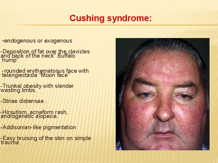 Cushing syndrome: -endogenous or exogenous -Deposition of fat over the clavicles and back of