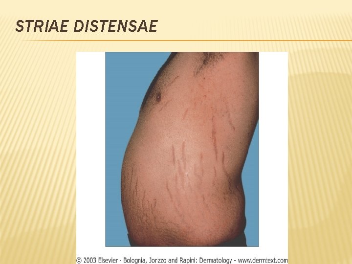 STRIAE DISTENSAE 