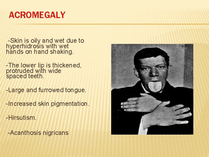 ACROMEGALY -Skin is oily and wet due to hyperhidrosis with wet hands on hand