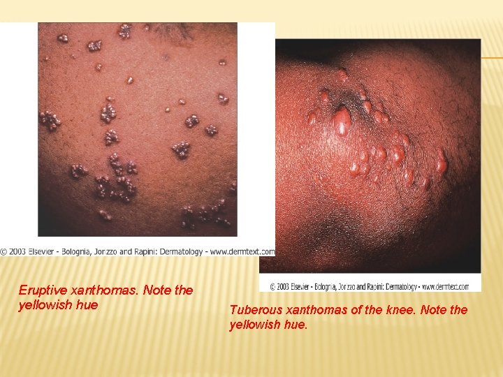 Eruptive xanthomas. Note the yellowish hue Tuberous xanthomas of the knee. Note the yellowish