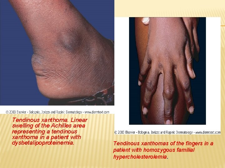 Tendinous xanthoma. Linear swelling of the Achilles area representing a tendinous xanthoma in a