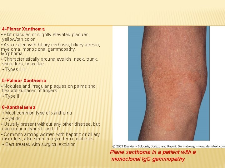 4 -Planar Xanthoma • Flat macules or slightly elevated plaques, yellow/tan color • Associated