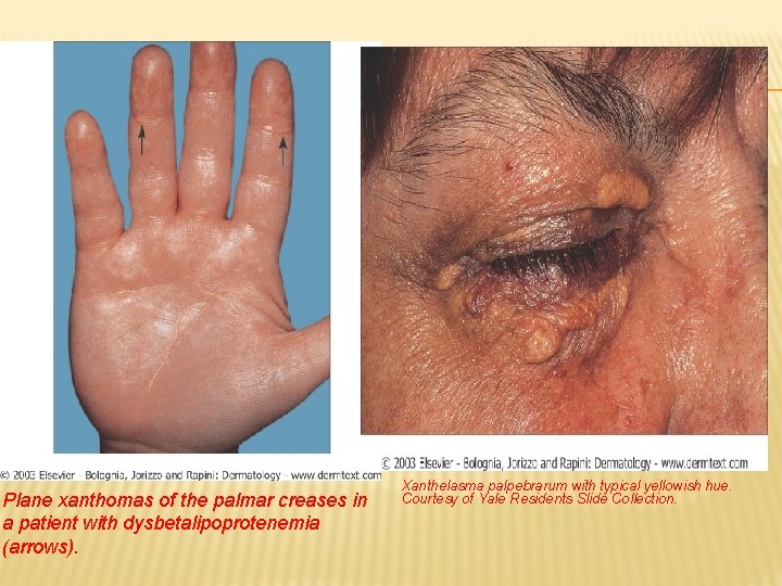 Plane xanthomas of the palmar creases in a patient with dysbetalipoprotenemia (arrows). Xanthelasma palpebrarum