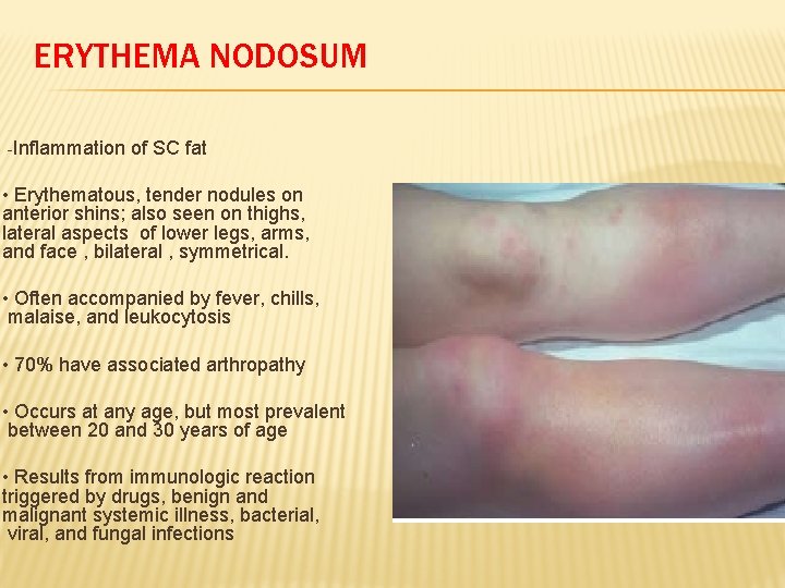 ERYTHEMA NODOSUM -Inflammation of SC fat • Erythematous, tender nodules on anterior shins; also