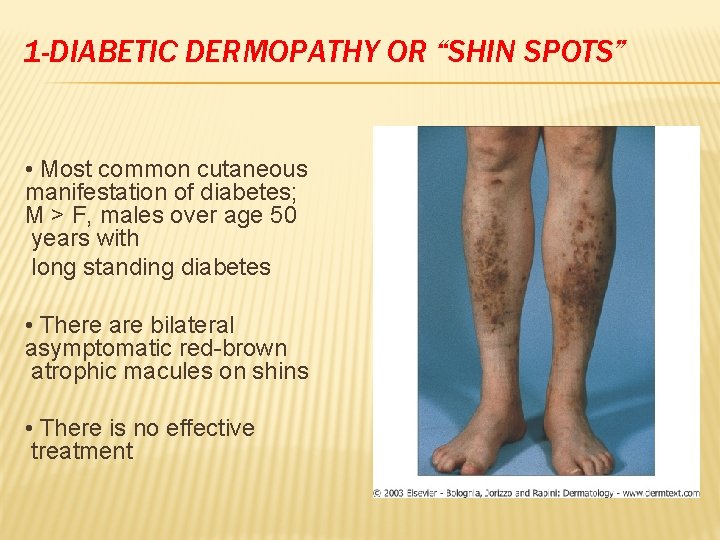 1 -DIABETIC DERMOPATHY OR “SHIN SPOTS” • Most common cutaneous manifestation of diabetes; M