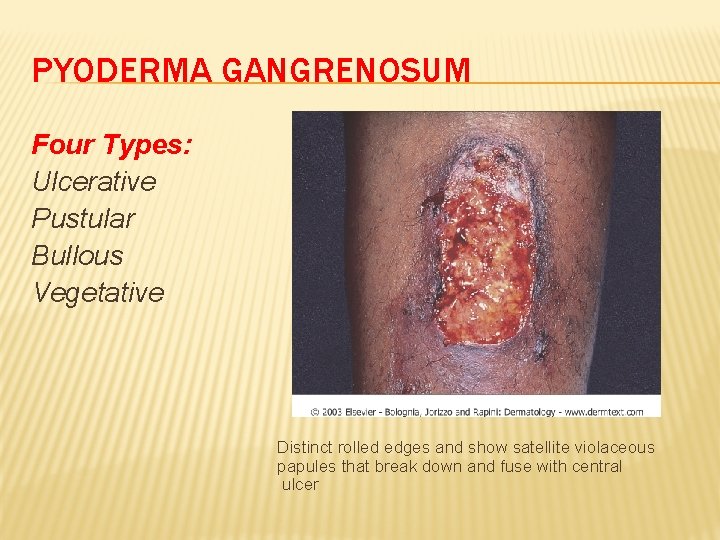 PYODERMA GANGRENOSUM Four Types: Ulcerative Pustular Bullous Vegetative Distinct rolled edges and show satellite