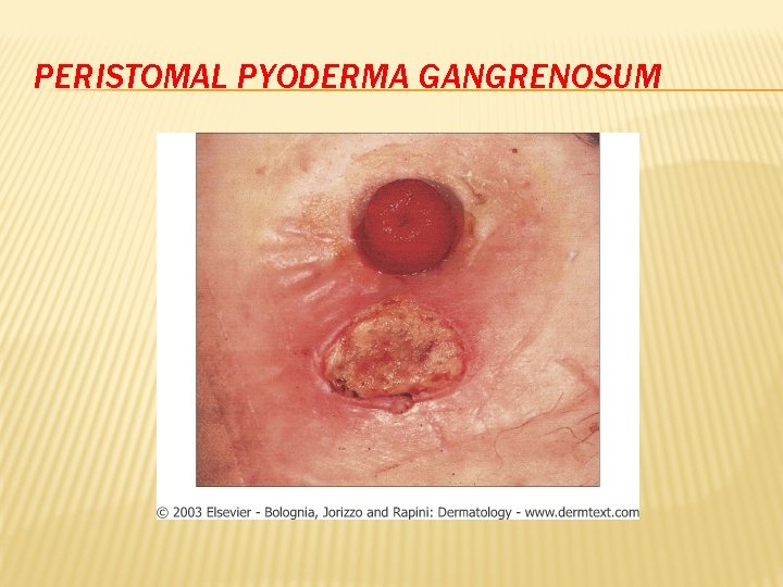 PERISTOMAL PYODERMA GANGRENOSUM 