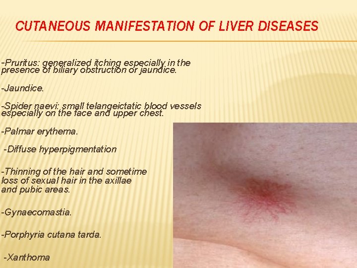 CUTANEOUS MANIFESTATION OF LIVER DISEASES -Pruritus: generalized itching especially in the presence of biliary