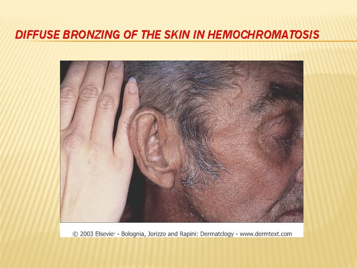 DIFFUSE BRONZING OF THE SKIN IN HEMOCHROMATOSIS 