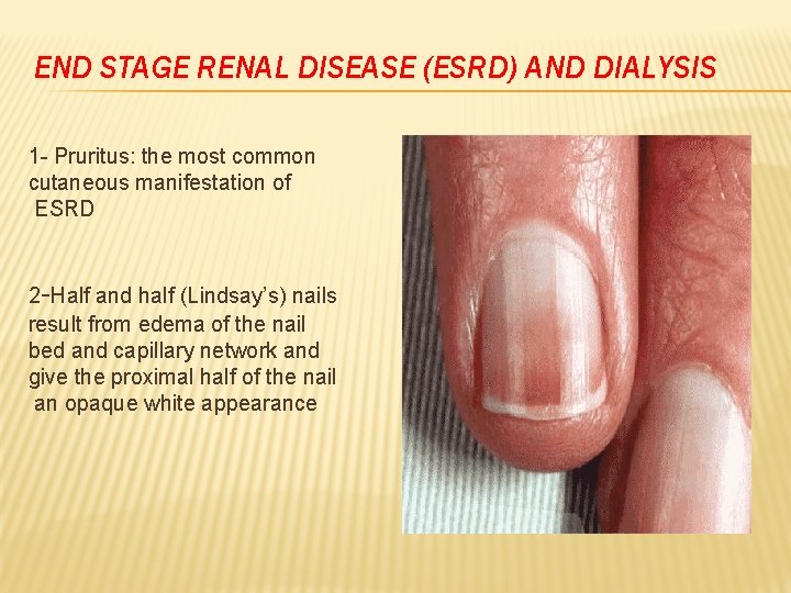 END STAGE RENAL DISEASE (ESRD) AND DIALYSIS 1 - Pruritus: the most common cutaneous