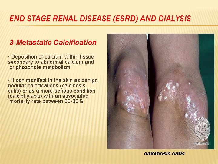 END STAGE RENAL DISEASE (ESRD) AND DIALYSIS 3 -Metastatic Calcification • Deposition of calcium