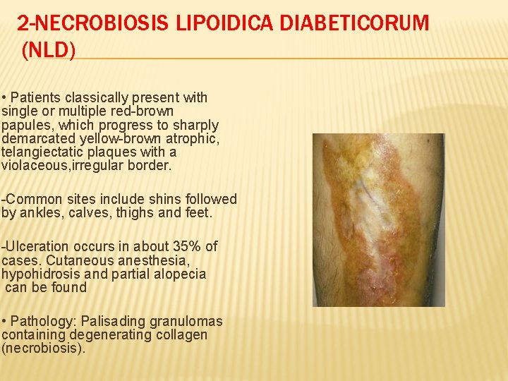 2 -NECROBIOSIS LIPOIDICA DIABETICORUM (NLD) • Patients classically present with single or multiple red-brown