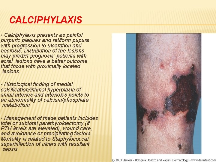 CALCIPHYLAXIS • Calciphylaxis presents as painful purpuric plaques and retiform pupura with progression to