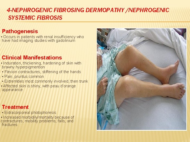 4 -NEPHROGENIC FIBROSING DERMOPATHY /NEPHROGENIC SYSTEMIC FIBROSIS Pathogenesis • Occurs in patients with renal