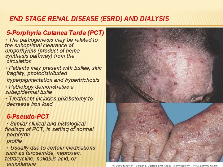 END STAGE RENAL DISEASE (ESRD) AND DIALYSIS 5 -Porphyria Cutanea Tarda (PCT) • The