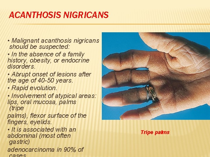 ACANTHOSIS NIGRICANS • Malignant acanthosis nigricans should be suspected: • In the absence of