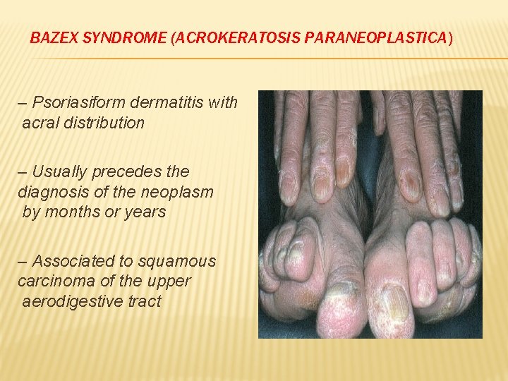 BAZEX SYNDROME (ACROKERATOSIS PARANEOPLASTICA) – Psoriasiform dermatitis with acral distribution – Usually precedes the