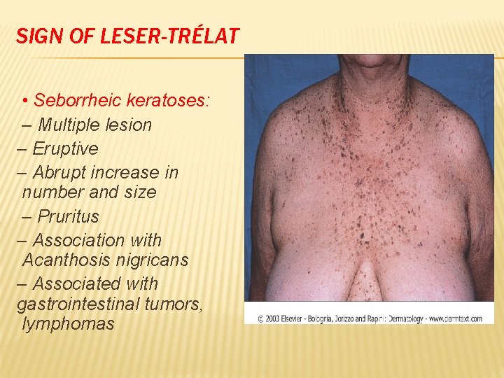 SIGN OF LESER-TRÉLAT • Seborrheic keratoses: – Multiple lesion – Eruptive – Abrupt increase