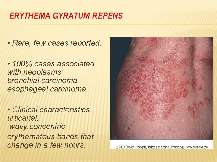 ERYTHEMA GYRATUM REPENS • Rare, few cases reported. • 100% cases associated with neoplasms: