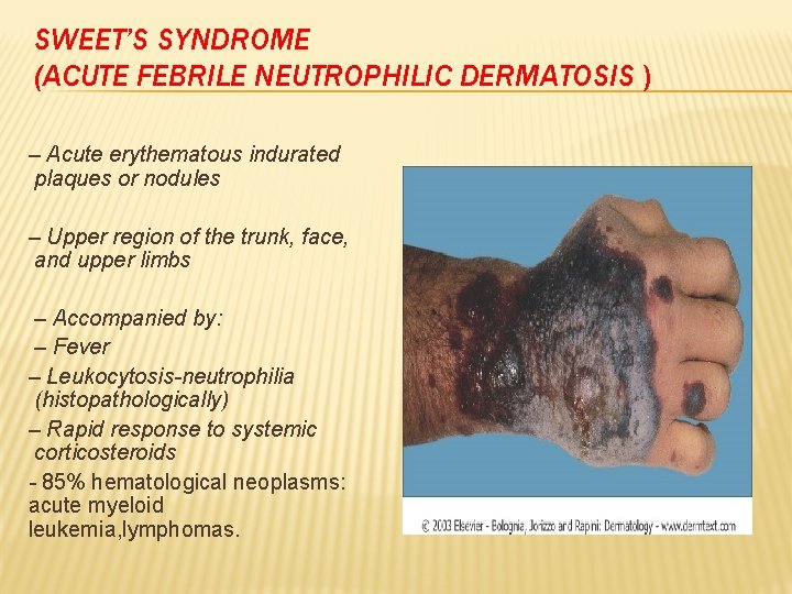 SWEET’S SYNDROME (ACUTE FEBRILE NEUTROPHILIC DERMATOSIS ) – Acute erythematous indurated plaques or nodules