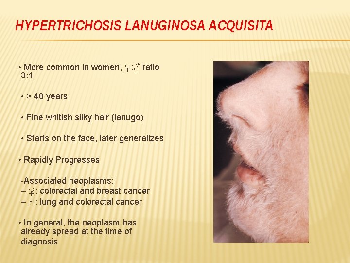 HYPERTRICHOSIS LANUGINOSA ACQUISITA • More common in women, ♀: ♂ ratio 3: 1 •