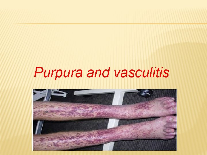 Purpura and vasculitis 