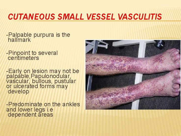 CUTANEOUS SMALL VESSEL VASCULITIS -Palpable purpura is the hallmark -Pinpoint to several centimeters -Early