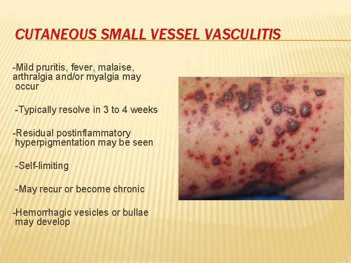 CUTANEOUS SMALL VESSEL VASCULITIS -Mild pruritis, fever, malaise, arthralgia and/or myalgia may occur -Typically