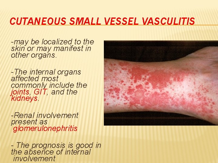 CUTANEOUS SMALL VESSEL VASCULITIS -may be localized to the skin or may manifest in