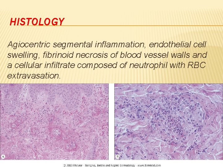 HISTOLOGY Agiocentric segmental inflammation, endothelial cell swelling, fibrinoid necrosis of blood vessel walls and