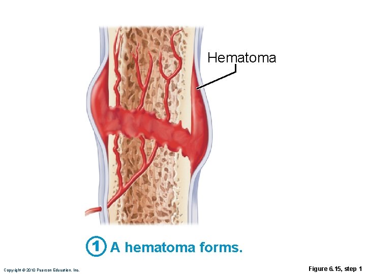 Hematoma 1 A hematoma forms. Copyright © 2010 Pearson Education, Inc. Figure 6. 15, Hematoma 1 A hematoma forms. Copyright © 2010 Pearson Education, Inc. Figure 6. 15,