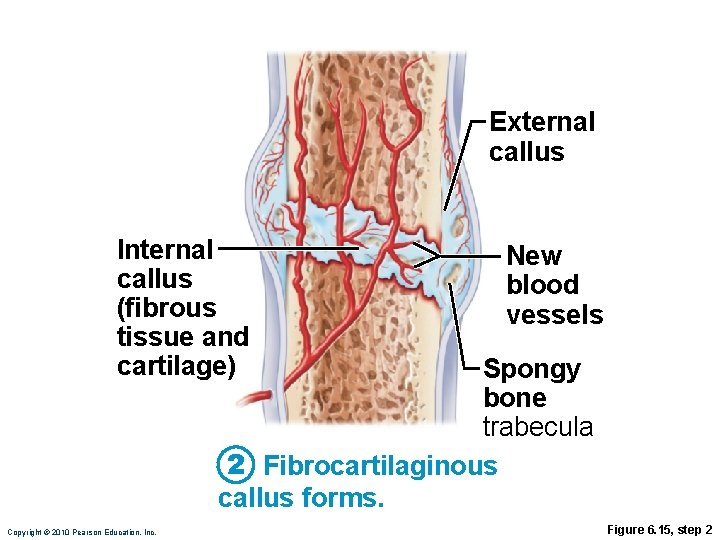 External callus Internal callus (fibrous tissue and cartilage) New blood vessels Spongy bone trabecula External callus Internal callus (fibrous tissue and cartilage) New blood vessels Spongy bone trabecula