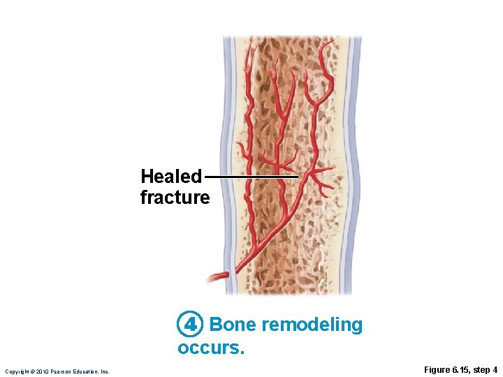 Healed fracture 4 Bone remodeling occurs. Copyright © 2010 Pearson Education, Inc. Figure 6. Healed fracture 4 Bone remodeling occurs. Copyright © 2010 Pearson Education, Inc. Figure 6.