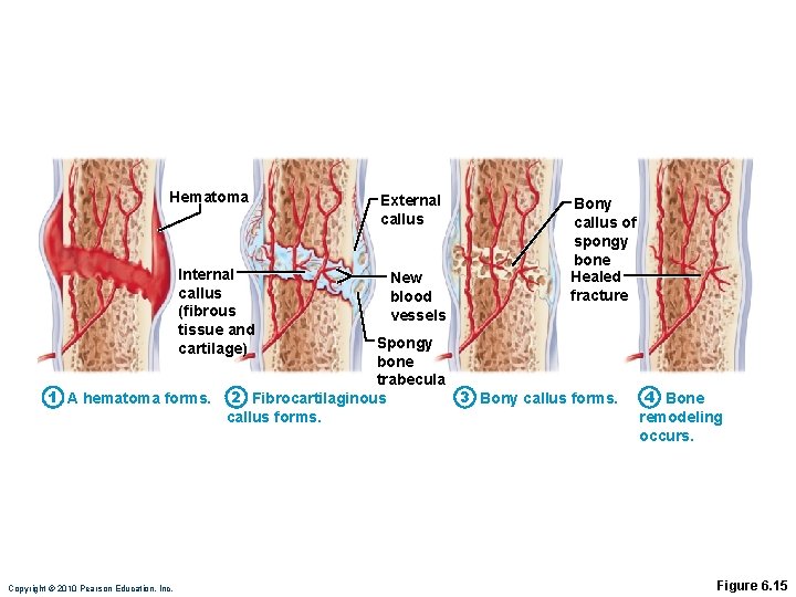 Hematoma Internal callus (fibrous tissue and cartilage) External callus New blood vessels Bony callus Hematoma Internal callus (fibrous tissue and cartilage) External callus New blood vessels Bony callus