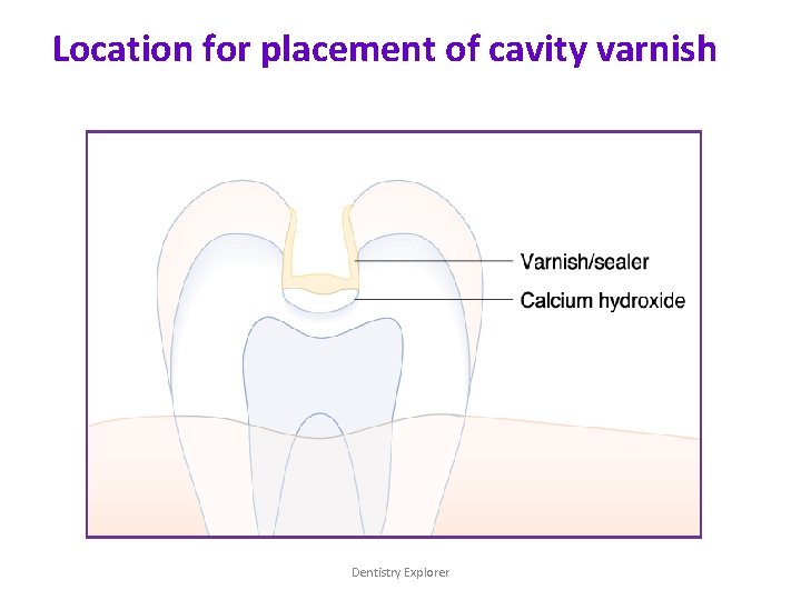 Location for placement of cavity varnish Dentistry Explorer 