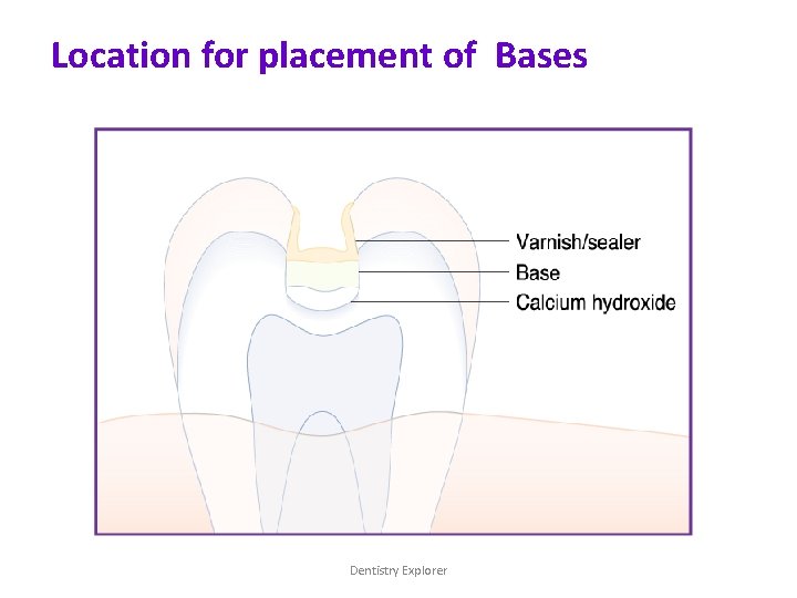 Location for placement of Bases Dentistry Explorer 