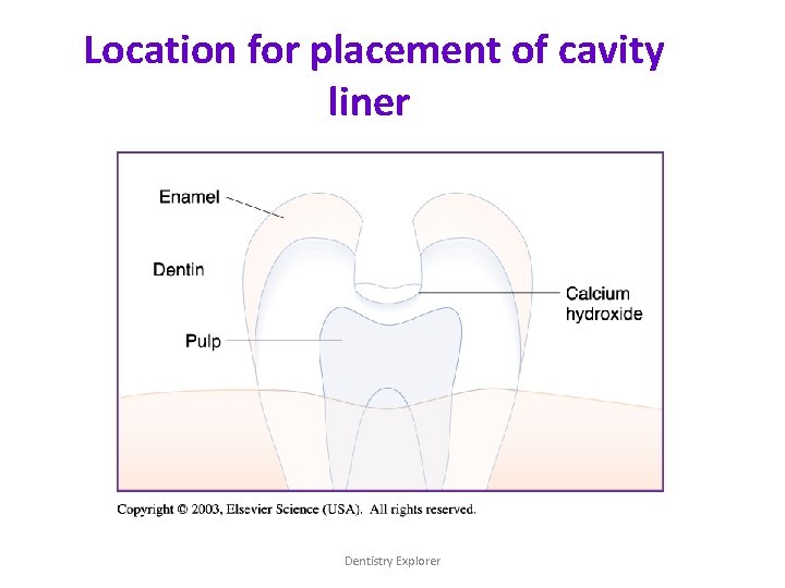 Location for placement of cavity liner Dentistry Explorer 