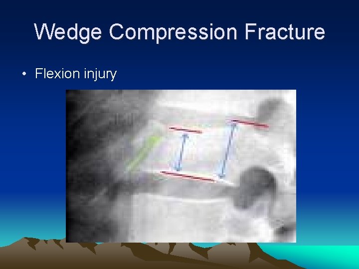 Wedge Compression Fracture • Flexion injury 