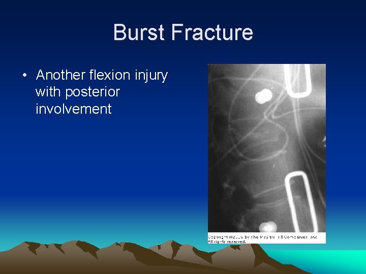 Burst Fracture • Another flexion injury with posterior involvement 