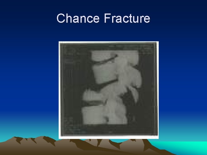 Chance Fracture 