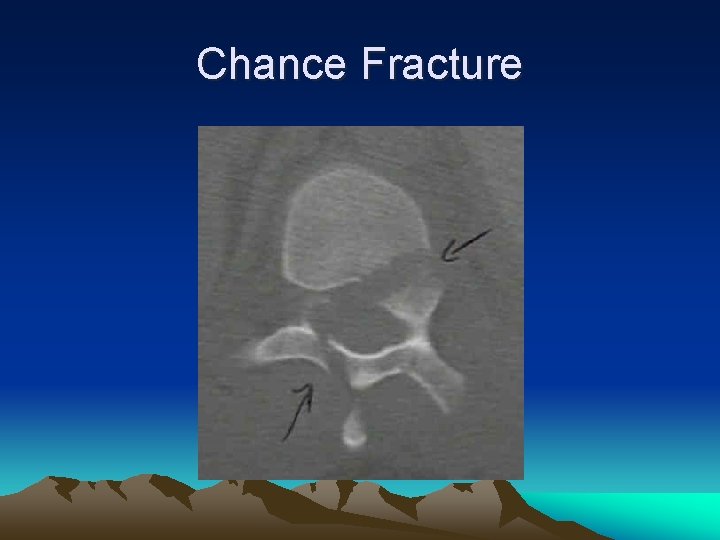 Chance Fracture 