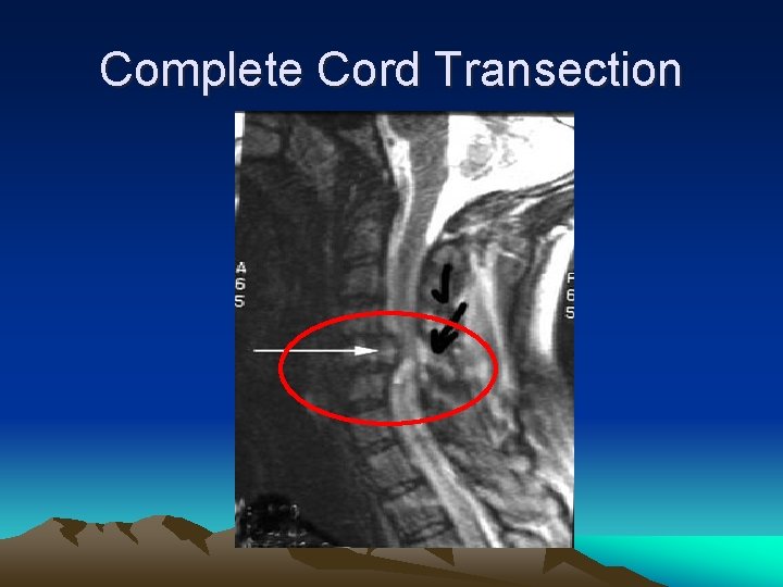 Complete Cord Transection 
