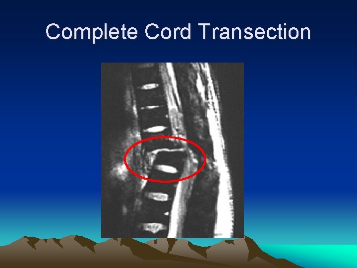 Complete Cord Transection 