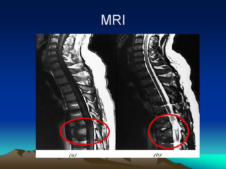 MRI 