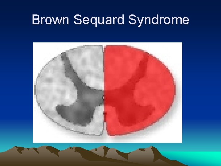 Brown Sequard Syndrome 