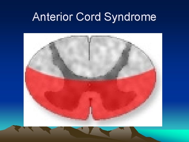 Anterior Cord Syndrome 