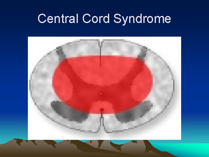 Central Cord Syndrome 