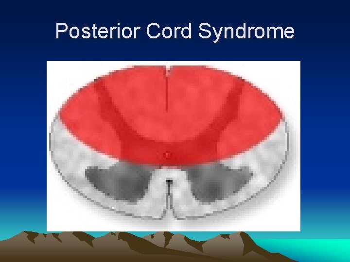 Posterior Cord Syndrome 